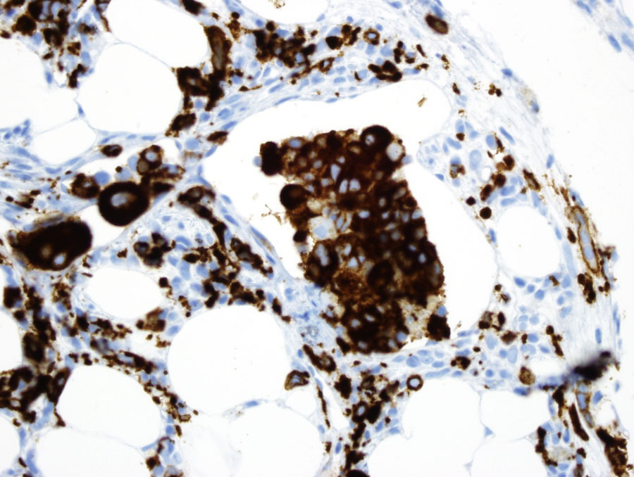 Fig 2C Refract dis BMX intrasinusoidal megakaryocytes CD61